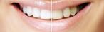Dentist, dentist, dentist whangarei, Dentist Whangarei, Whangarei, dentistry, oral hygiene, dental health, dental health services, family dentist, white teeth, affordable dentist whangarei, best dentist whangarei, Smilecare, smilecare